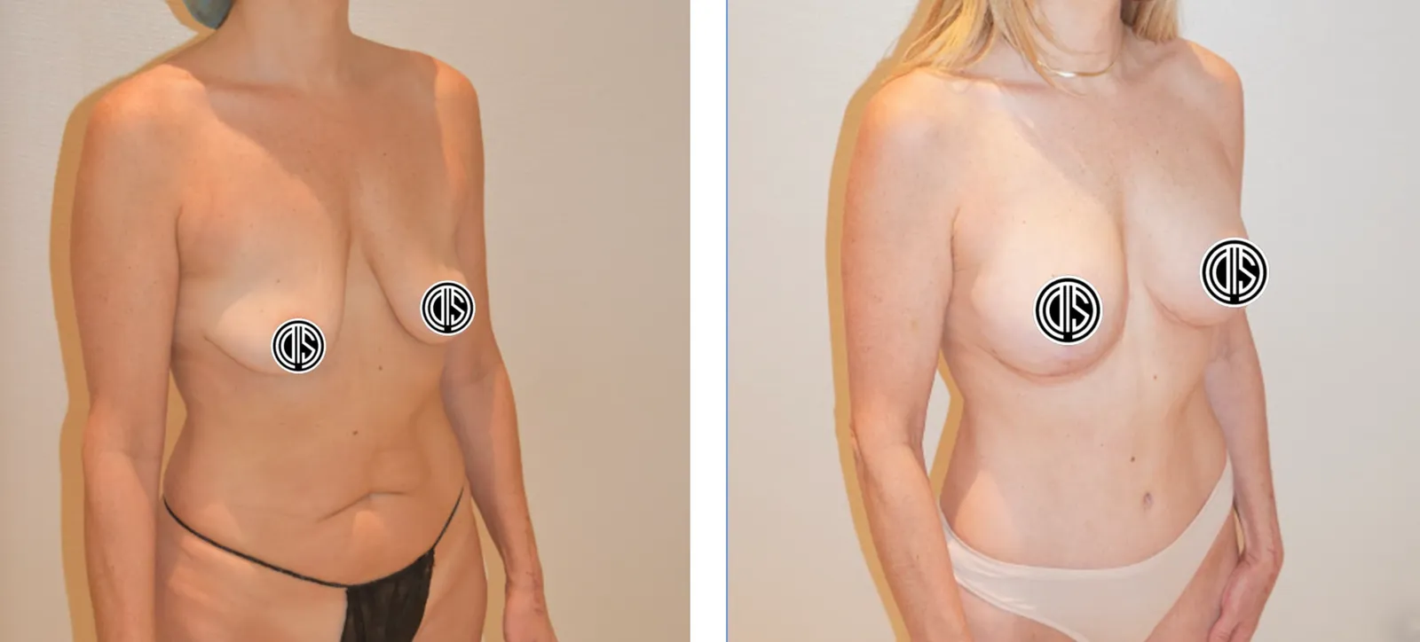 Actual patient of Dr. Smith — before and after a breast lift, breast augmentation, and abdominoplasty