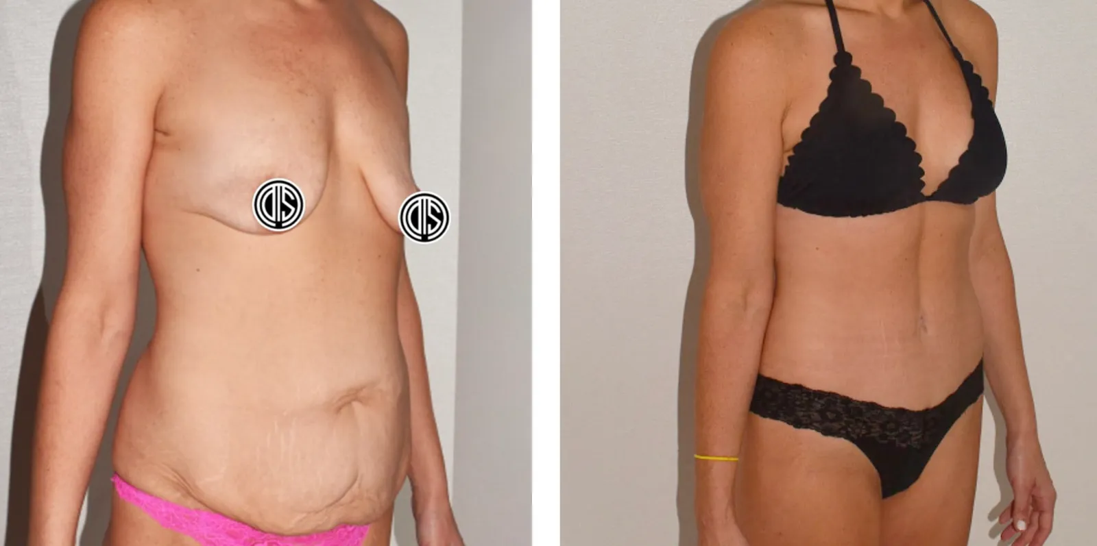 Actual patient of Dr. Smith — before and after a breast lift, breast augmentation, and abdominoplasty following major weight loss